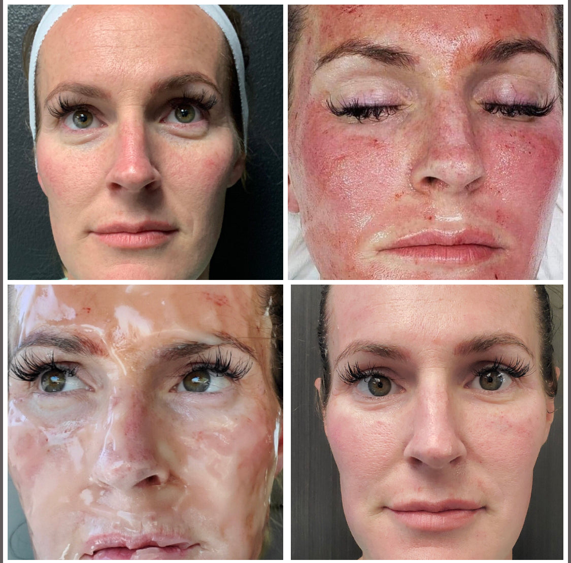 CO2 Lift Pro Treatment
