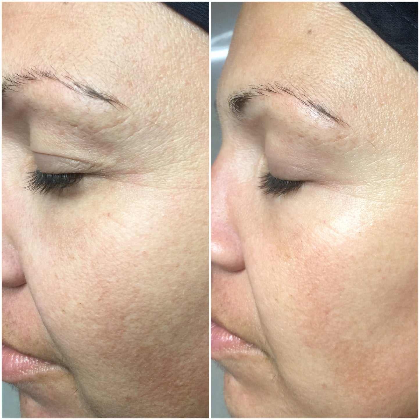 CO2 Lift Pro Treatment